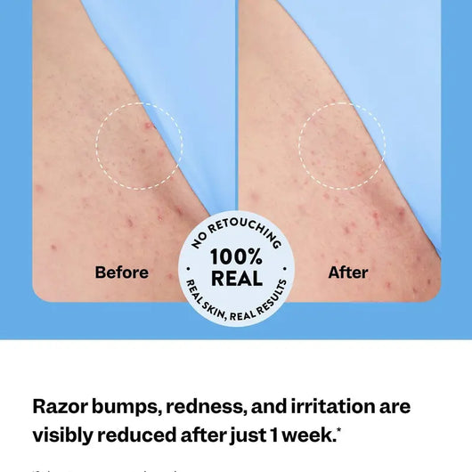 Skin Smoothing Solution For Bumps, Ingrown Hairs, & Dark Spots